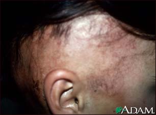 Alopecia, under treatment Alopecia, under treatment