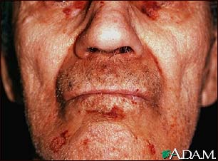 Amyloidosis on the face Amyloidosis on the face
