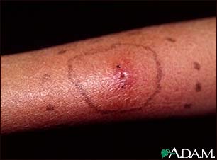 Cellulitis Cellulitis