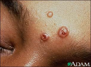 Cryptococcosis on the forehead Cryptococcosis on the forehead