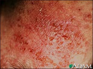 Dermatitis, close-up of allergic contact Dermatitis, close-up of allergic contact