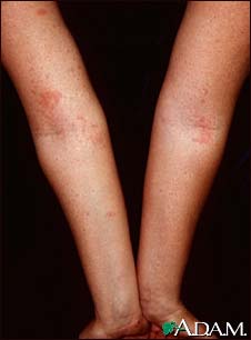 Dermatitis, atopic on the arms Dermatitis, atopic on the arms