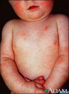 Dermatitis, atopic in an infant Dermatitis, atopic in an infant