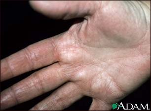 Hyperlinearity in atopic dermatitis, on the palm Hyperlinearity in atopic dermatitis, on the palm