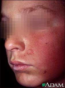 Dermatitis, contact on the cheek Dermatitis, contact on the cheek