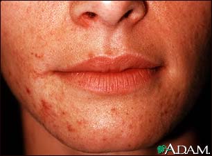 Dermatitis, perioral Dermatitis, perioral