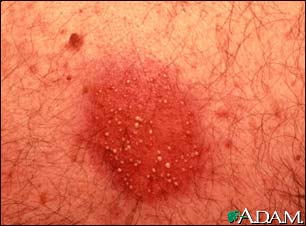 Dermatitis, pustular contact Dermatitis, pustular contact