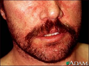 Dermatitis, seborrheic on the face Dermatitis, seborrheic on the face