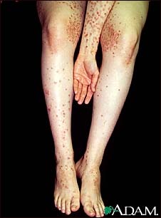 Dermatitis, herpetiformis on the arm and legs Dermatitis, herpetiformis on the arm and legs