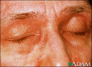 Dermatomyositis, heliotrope eyelids Dermatomyositis, heliotrope eyelids