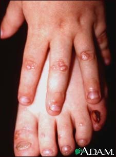 Epidermolysis bullosa, dominant dystrophic Epidermolysis bullosa, dominant dystrophic