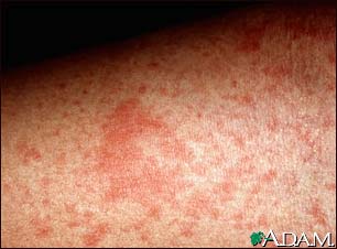 Eczema, atopic - close-up Eczema, atopic - close-up
