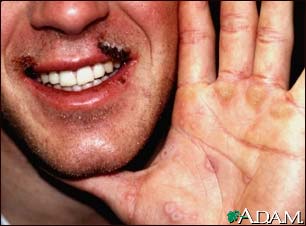 Erythema multiforme on the hand Erythema multiforme on the hand