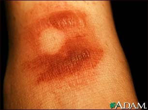 Fixed drug eruption, bullous Fixed drug eruption, bullous