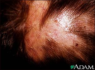 Folliculitis, decalvans on the scalp Folliculitis, decalvans on the scalp