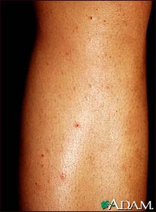 Folliculitis on the leg Folliculitis on the leg