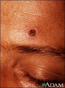 Histoplasmosis, disseminated in HIV patient Histoplasmosis, disseminated in HIV patient