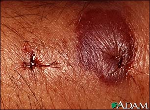 Insect bite reaction - close-up Insect bite reaction - close-up