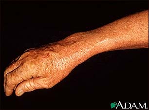 Lentigo, solar with erythema on the arm Lentigo, solar with erythema on the arm