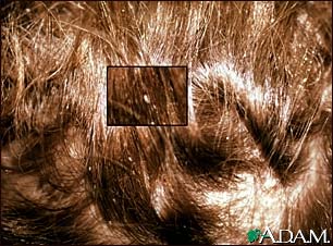 Lice, head - nits in the hair with close-up Lice, head - nits in the hair with close-up