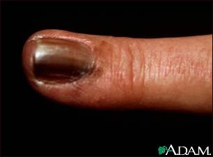 Skin cancer, melanoma on the fingernail Skin cancer, melanoma on the fingernail