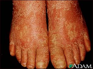 Pityriasis rubra pilaris on the feet Pityriasis rubra pilaris on the feet