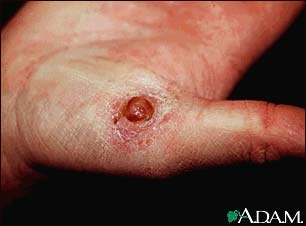 Pyogenic granuloma on the hand Pyogenic granuloma on the hand