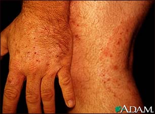 Ringworm, tinea on the hand and leg Ringworm, tinea on the hand and leg