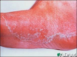 Athlete's foot, tinea pedis Athlete's foot, tinea pedis