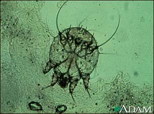 Scabies mite, photomicrograph Scabies mite, photomicrograph